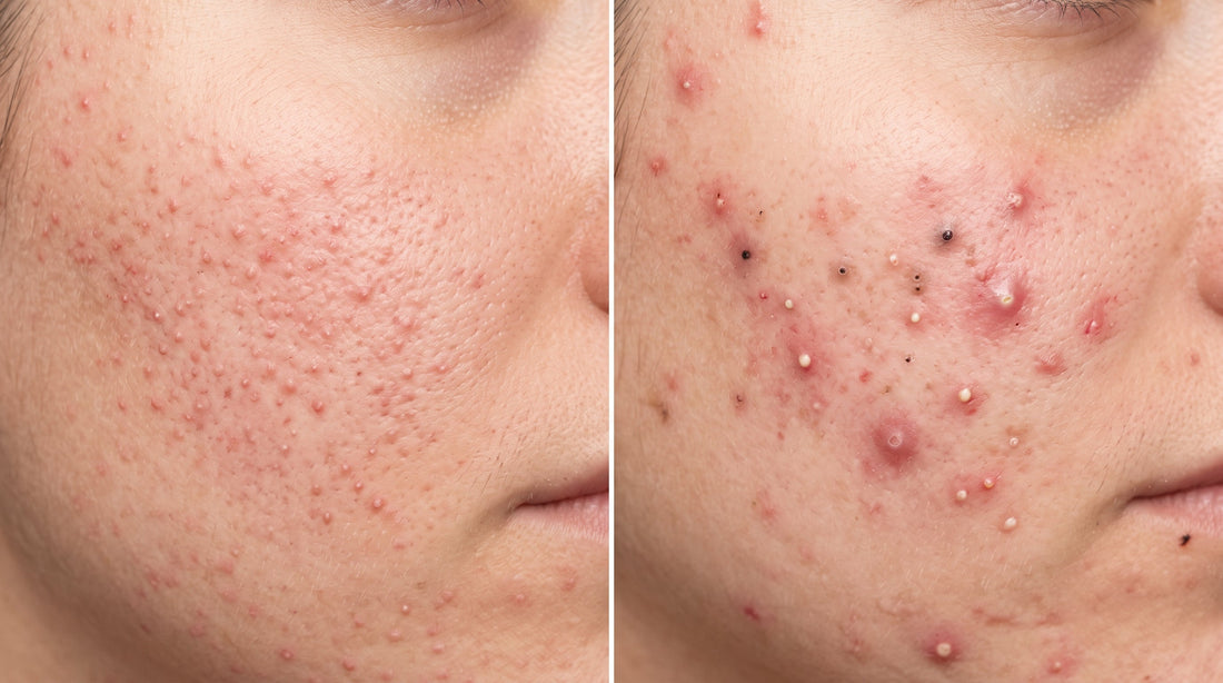 Skin comparison of Normal acne and fungal acne.