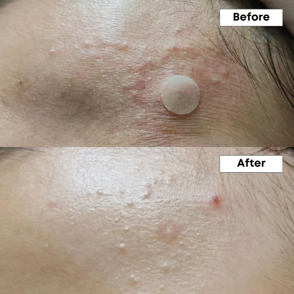 Nineless A-Control 10% Azelaic Acid  30ml