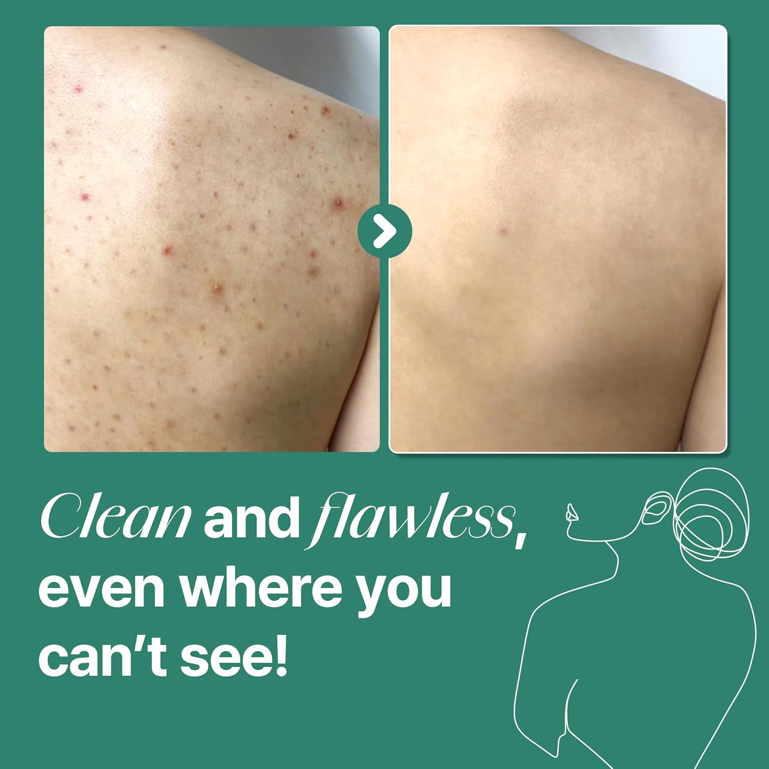 Second Chance SOME BY MI AHA BHA PHA 30 Days Miracle Acne Clear Body Cleanser 400g