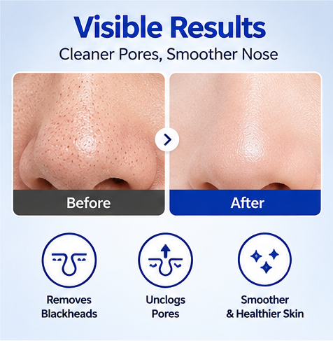 One-day’s You P.Z. SSOC SSOC No More Blackhead Nose Pack – 5 Sheets